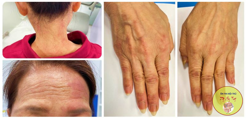 VIÊM ĐA CƠ & VIÊM DA CƠ TỰ MIỄN