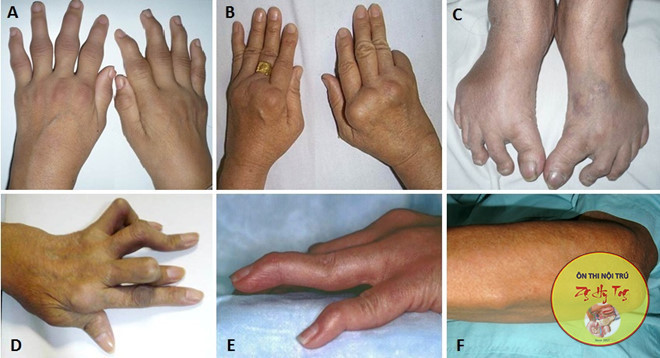 VIÊM KHỚP DẠNG THẤP