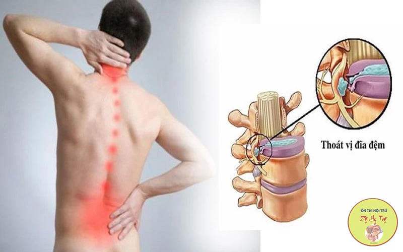 ĐAU VÙNG THẮT LƯNG & ĐAU THẦN KINH NGỒI DO THOÁT VỊ ĐĨA ĐỆM