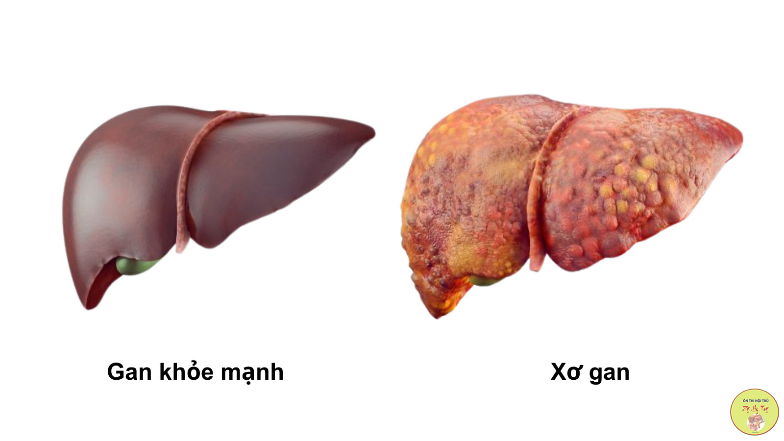 UNG THƯ BIỂU MÔ TẾ BÀO GAN