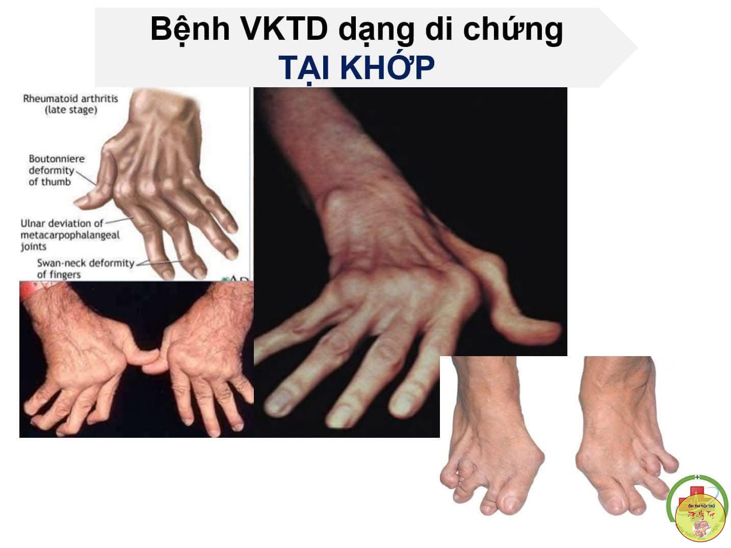 Viêm