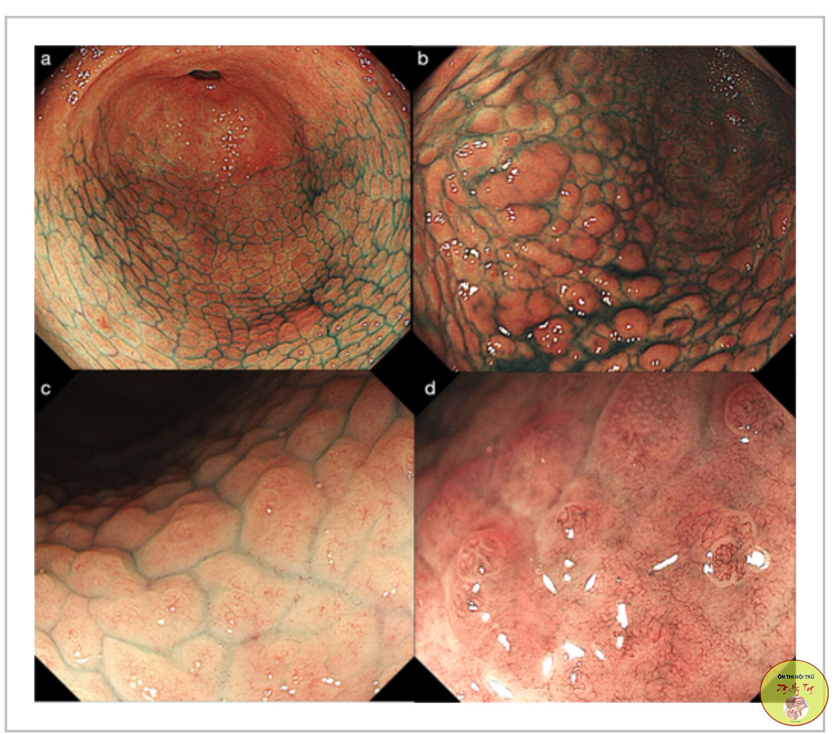 VIÊM DẠ DÀY COLLAGEN DẠNG CÁ HỒI